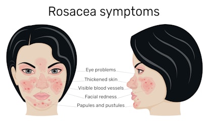 Common symptoms of rosacea.
